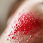 Allergie au soleil : causes, symptômes et solutions pour traiter les boutons et soulager la lucite