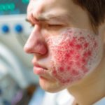 Allergie à la pénicilline : comment la détecter et la traiter ? Mythes et réalités