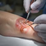 Dermatologist treating a burn on a foot