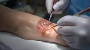 Dermatologist treating a burn on a foot