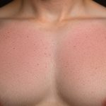 Torse d'homme avec éruption cutanée rouge