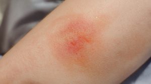 Reddened skin rash on arm