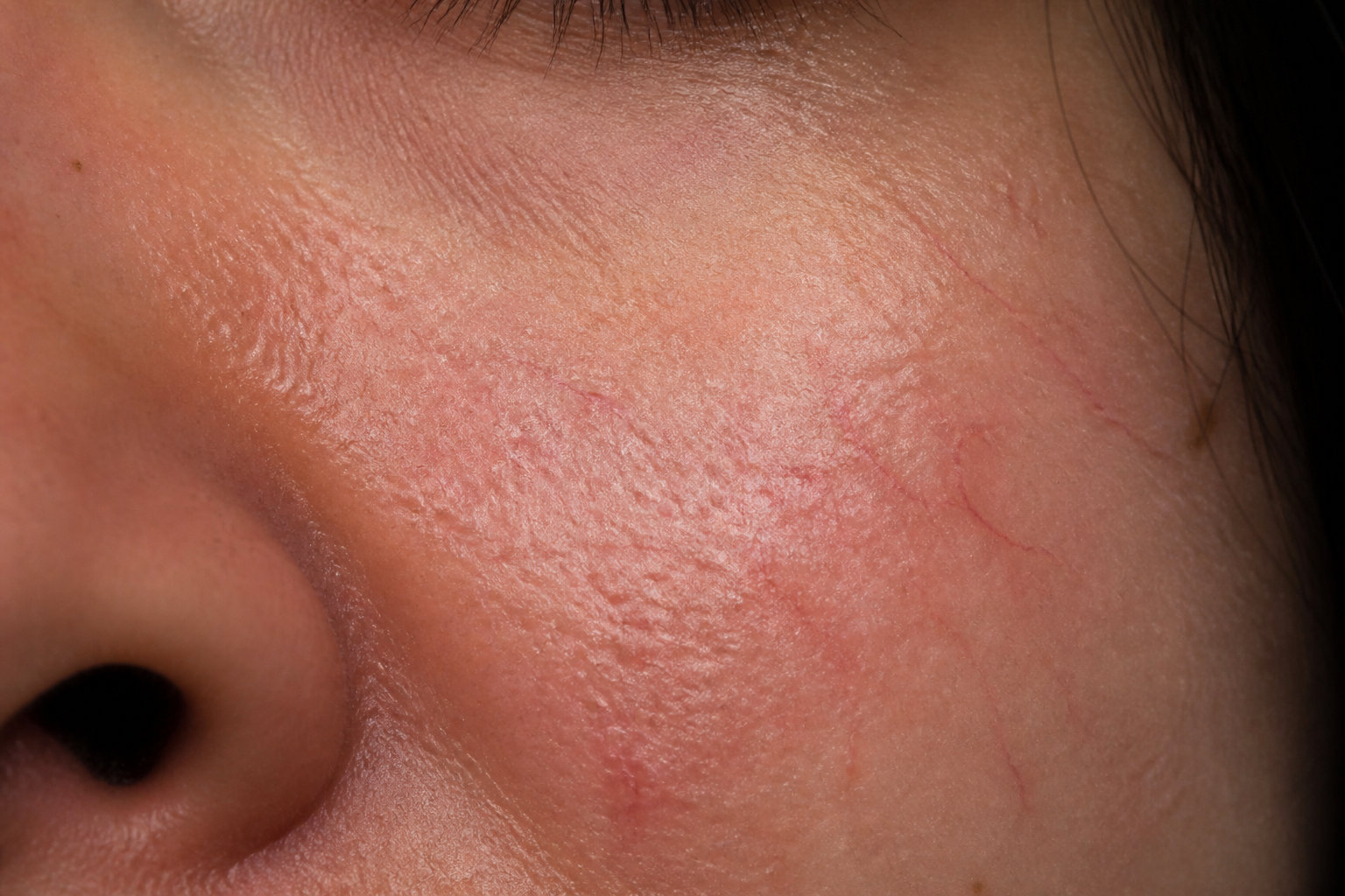 Comment faire disparaître la rosacée et ses rougeurs 1 Mécanismes biologiques de l'inflammation cutanée faciale